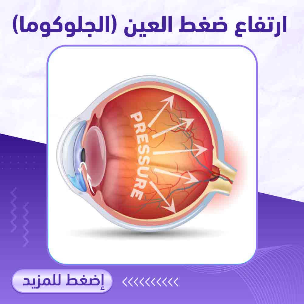 ارتفاع ضغط العين - صيدلية ميلانو