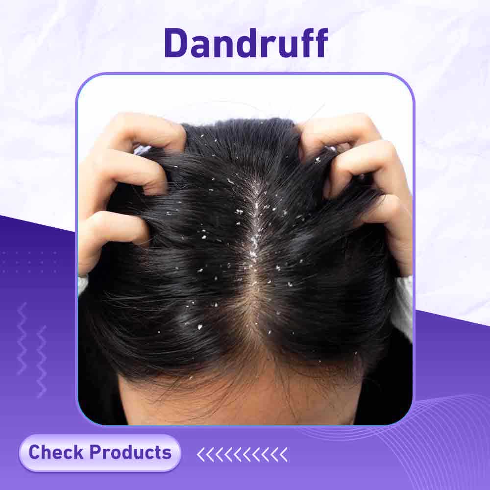 dandruff - Milano Pharmacy