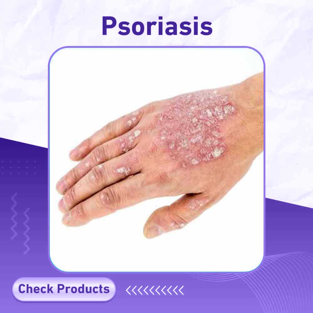 psoriasis - Milano Pharmacy