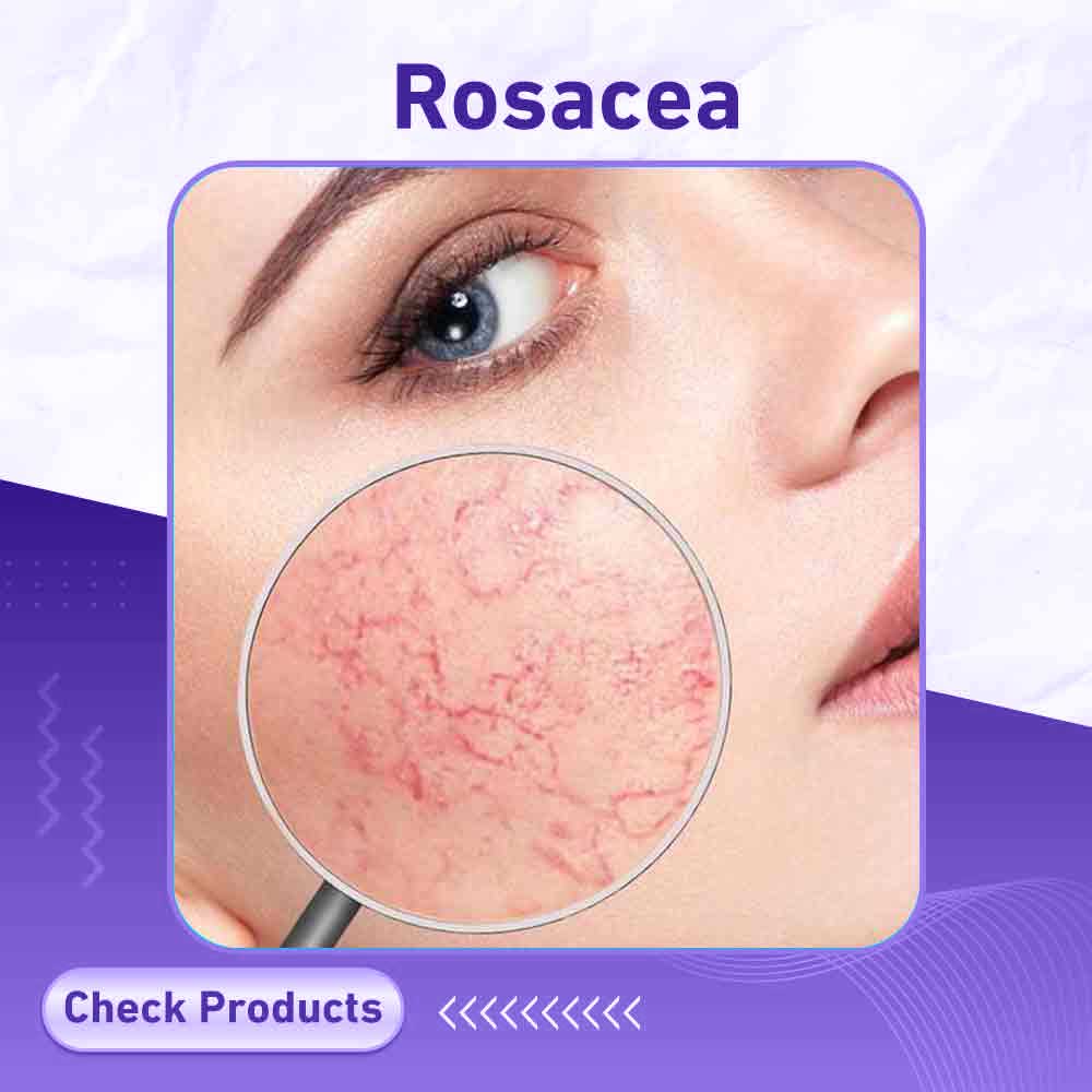 rosacea - Milano Pharmacy