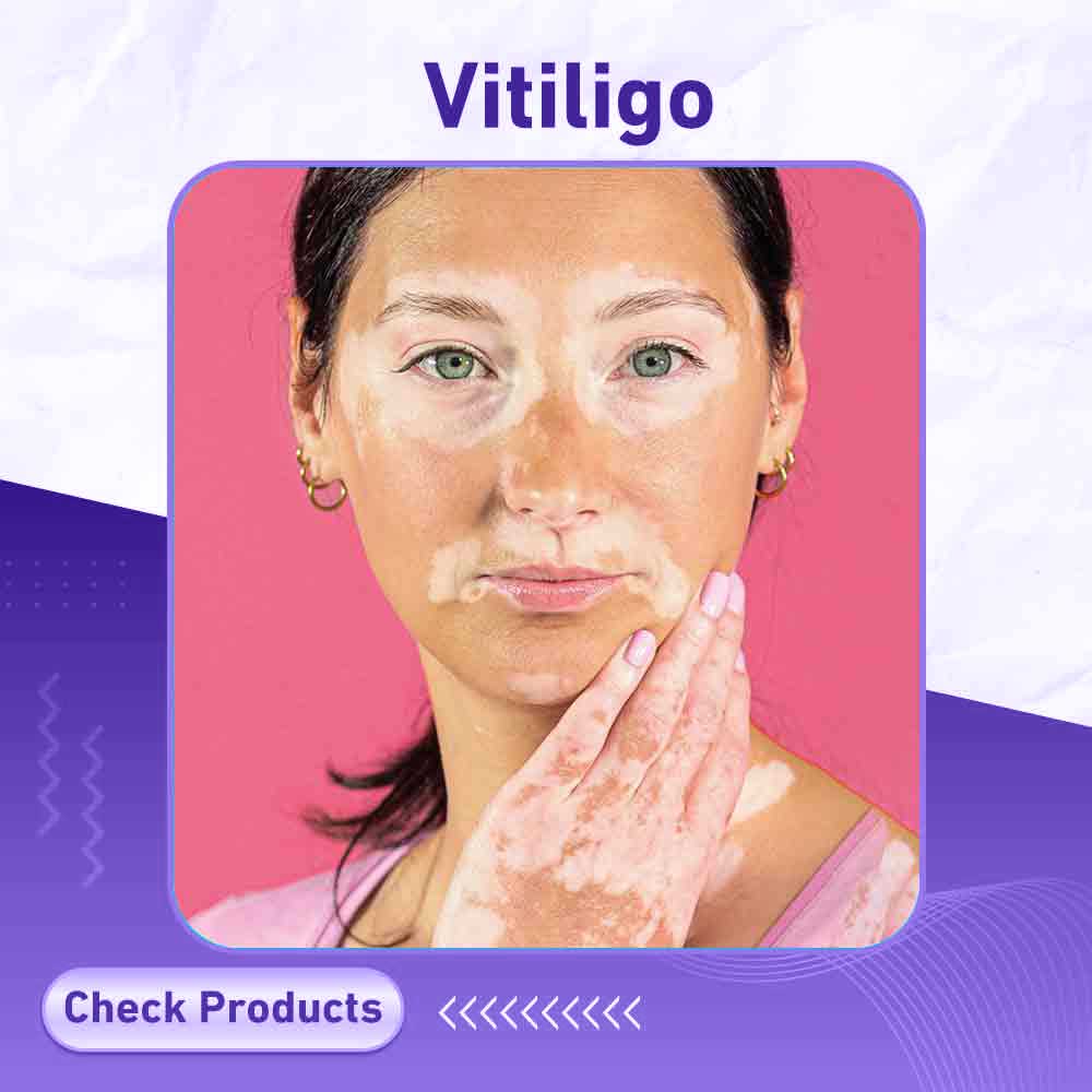 vitiligo - Milano Pharmacy