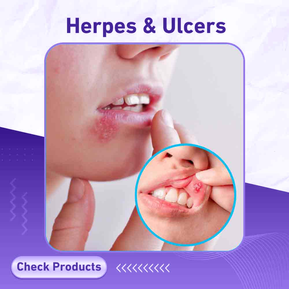 Herpes & Ulcers - Milano Pharmacy