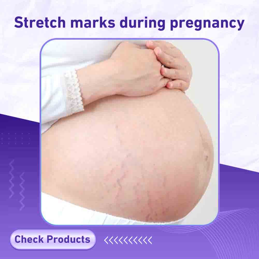 Stretch marks during pregnancy - Milano Pharmacy