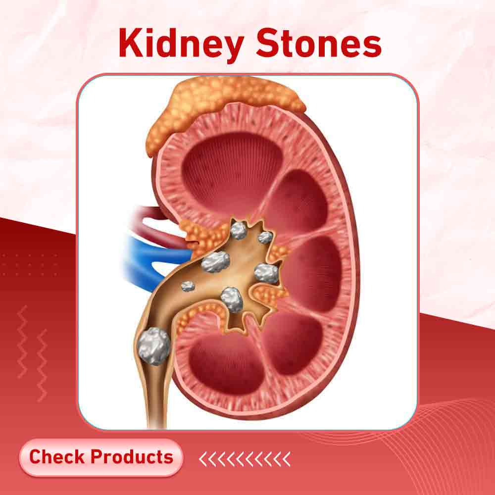 Kidney Stones - Milano Pharmacy